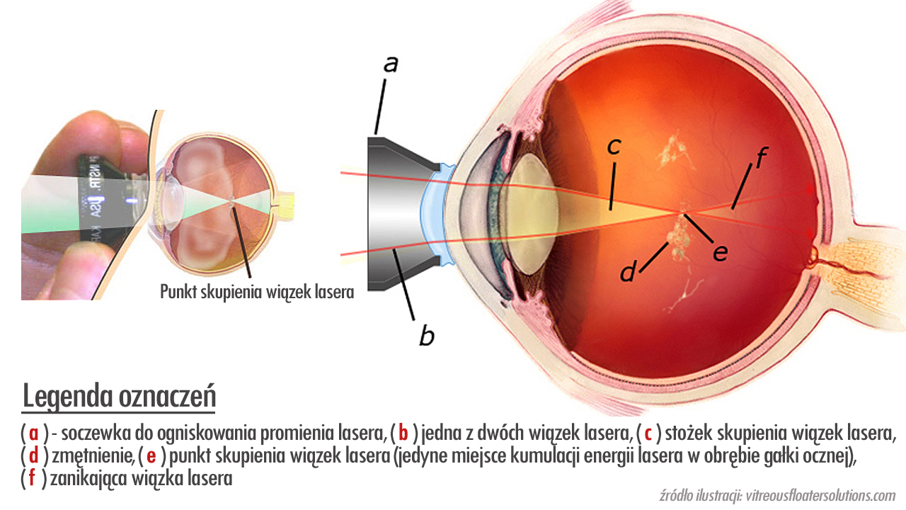 Прозрачное тело в глазу. Лазерный витреолизис и стекловидное тело /. Витреолизис стекловидного тела. Деструкция витреолизис.